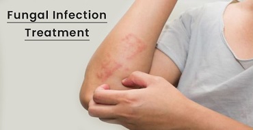 Fungal Infection Treatment in Ahmedabad, Treatment for Fungal Infection ...